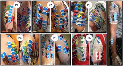New insights into muscle activity associated with phantom hand movements in transhumeral amputees